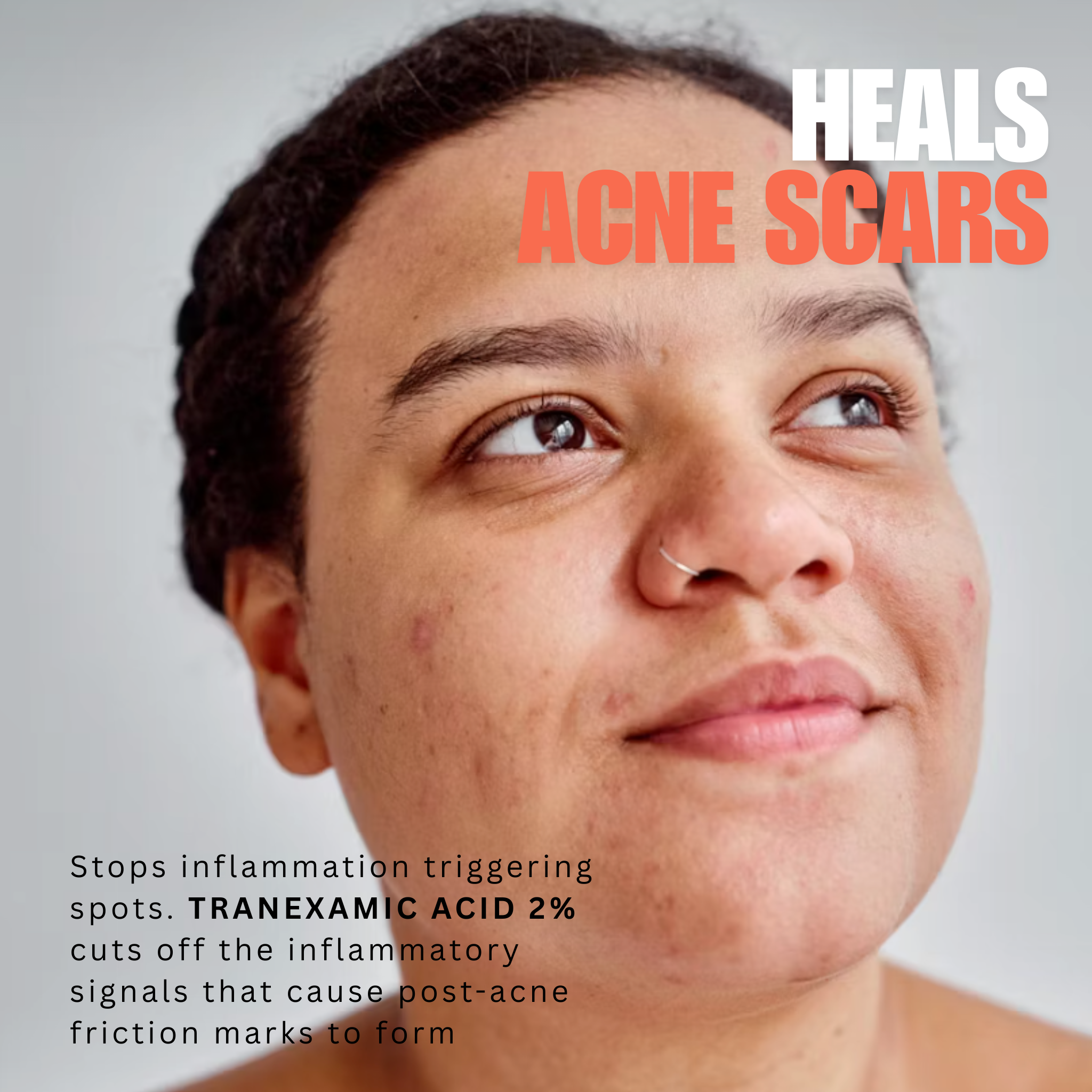 Advanced Triple Acid Complex For Hyperpigmentation